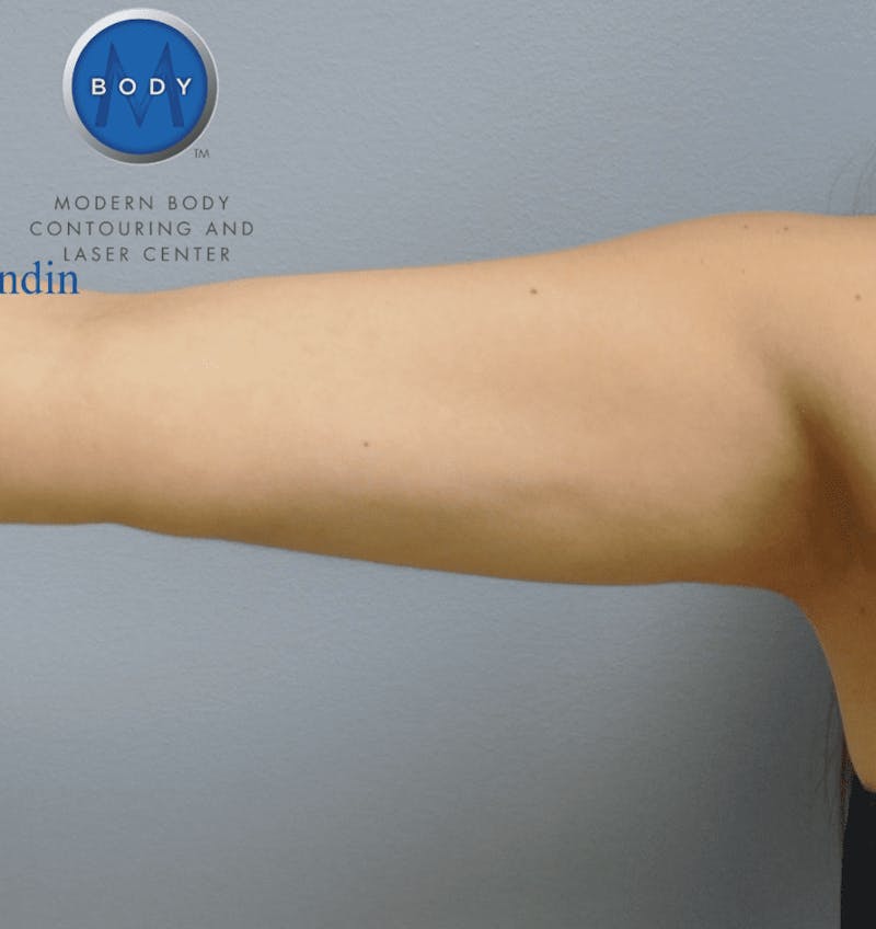 JPlasma Before & After Gallery - Patient 55345115 - Image 2
