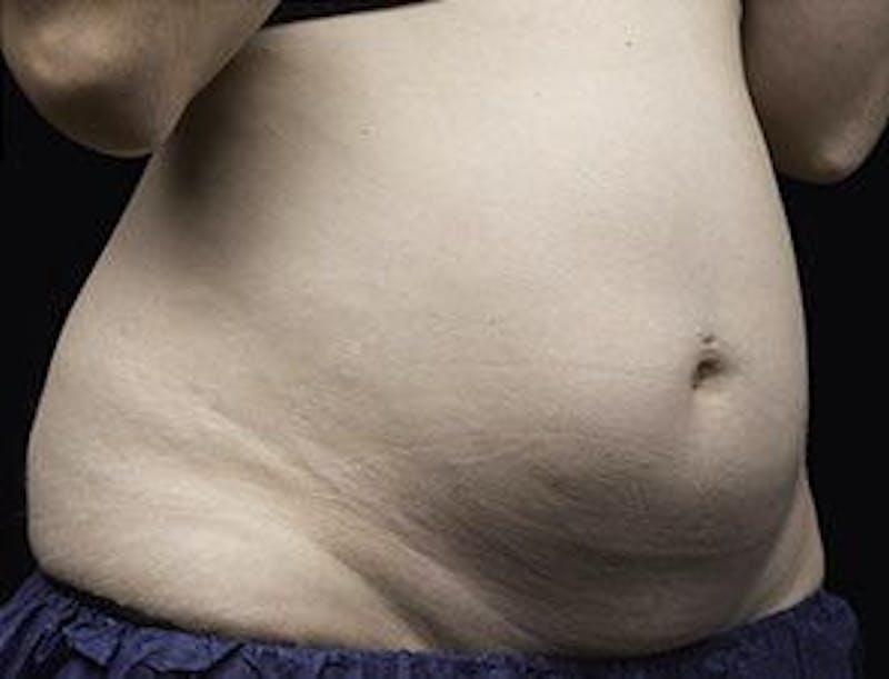 Liposonix Before & After Gallery - Patient 55345117 - Image 1