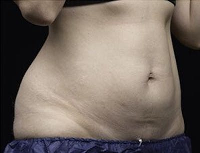 Liposonix Before & After Gallery - Patient 55345117 - Image 2