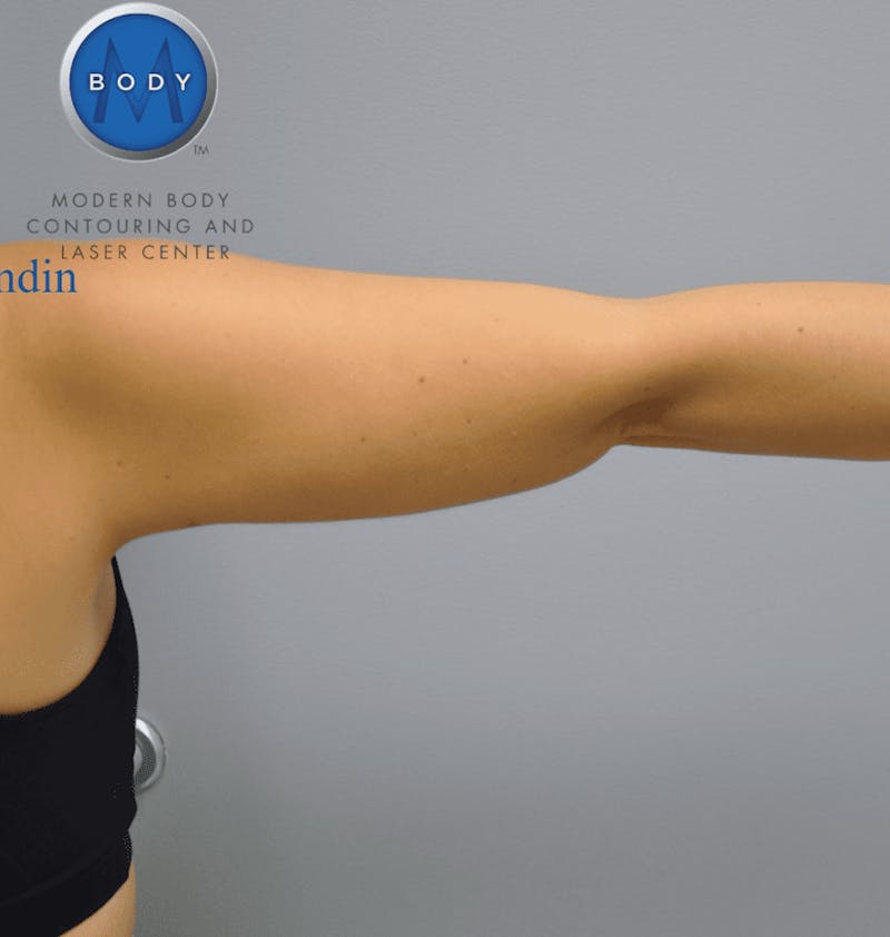 JPlasma Before & After Gallery - Patient 55345115 - Image 4