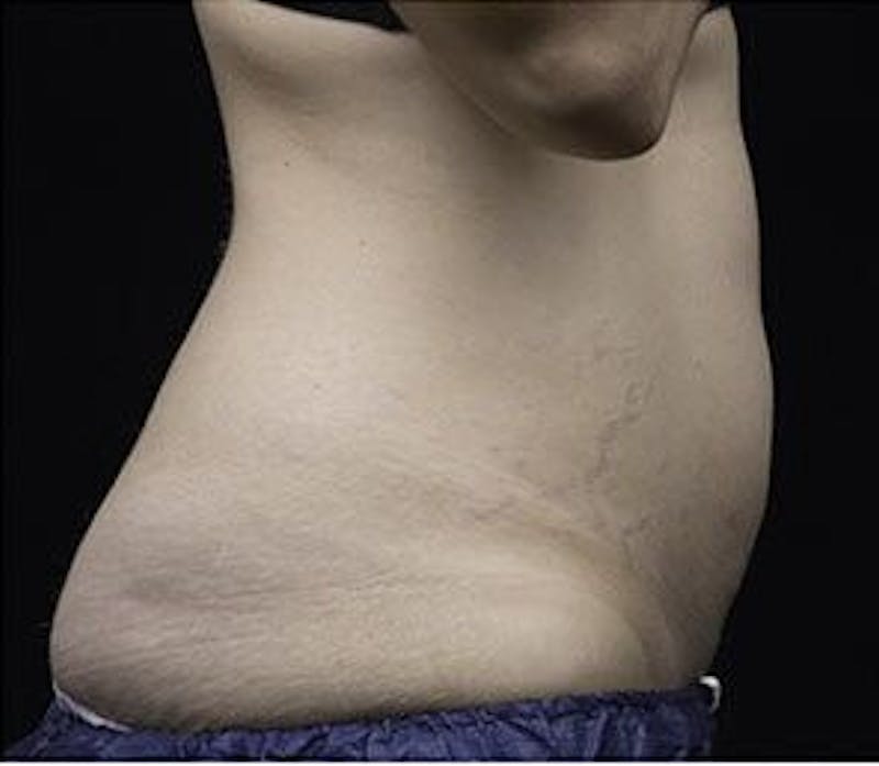 Liposonix Before & After Gallery - Patient 55345117 - Image 6