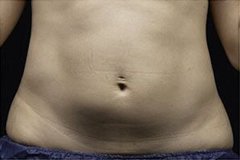 Liposonix Before & After Gallery - Patient 55345124 - Image 1
