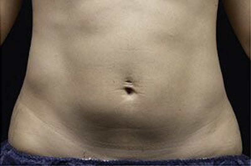 Liposonix Before & After Gallery - Patient 55345124 - Image 2