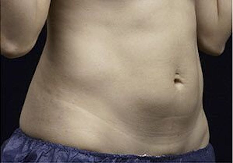 Liposonix Before & After Gallery - Patient 55345124 - Image 4