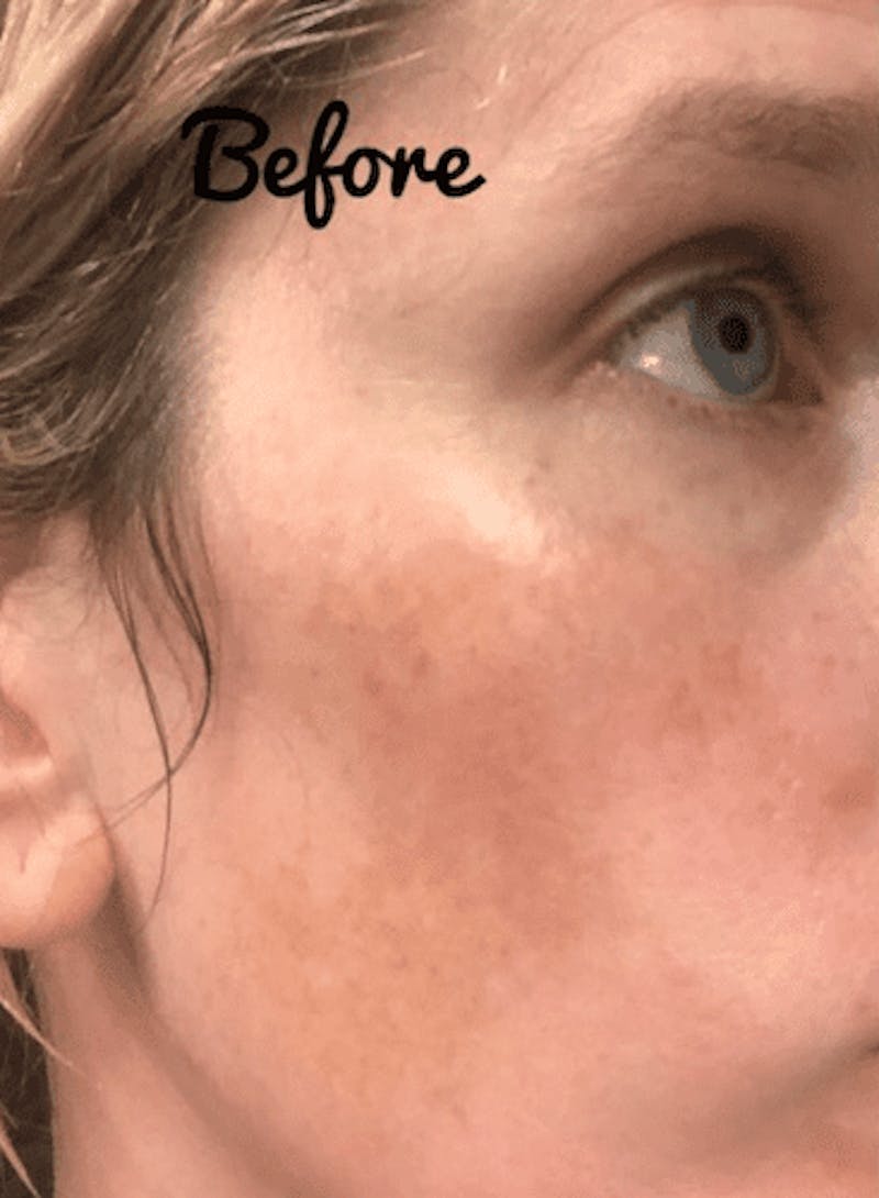 Skinprint Before & After Gallery - Patient 55345126 - Image 3