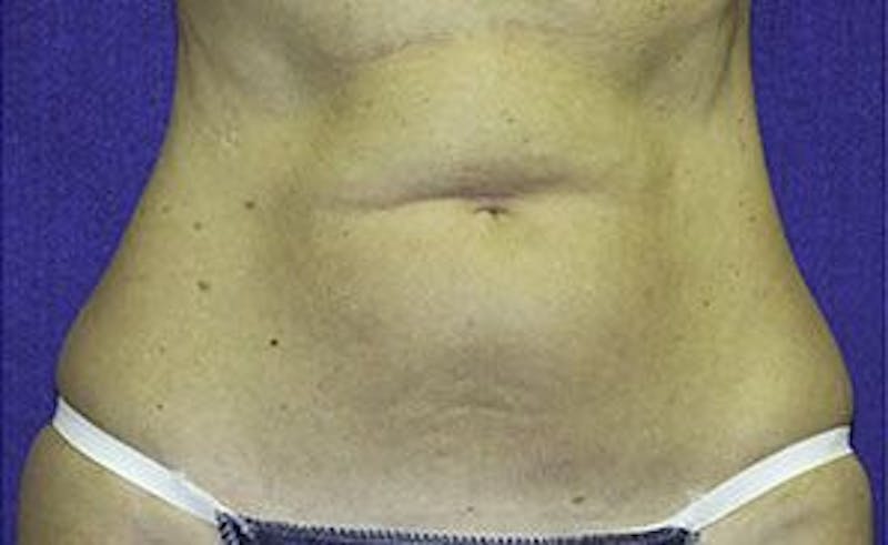 Liposonix Before & After Gallery - Patient 55345129 - Image 1