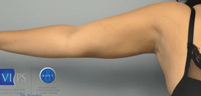 JPlasma Before & After Gallery - Patient 55345130 - Image 2