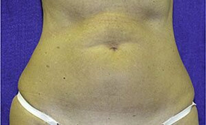 Liposonix Before & After Gallery - Patient 55345129 - Image 2