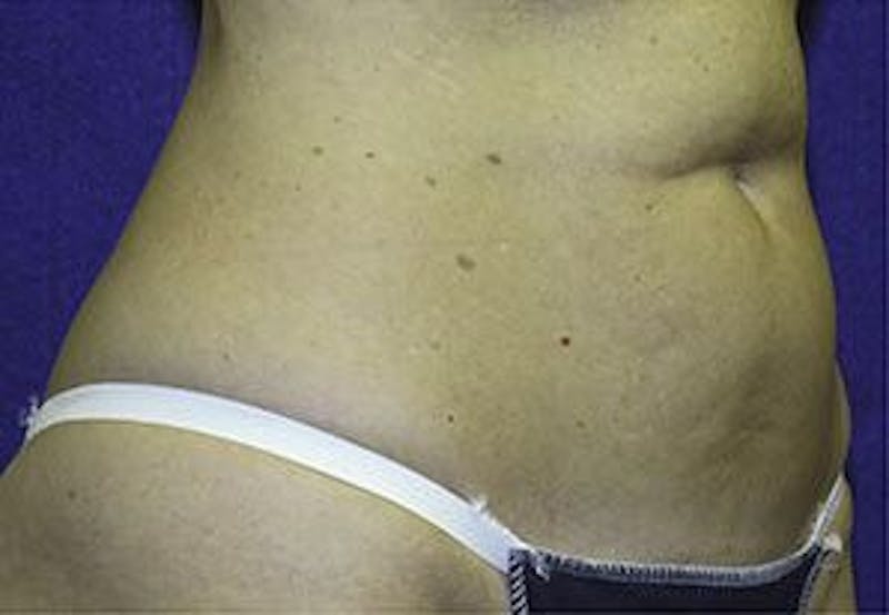 Liposonix Before & After Gallery - Patient 55345129 - Image 3
