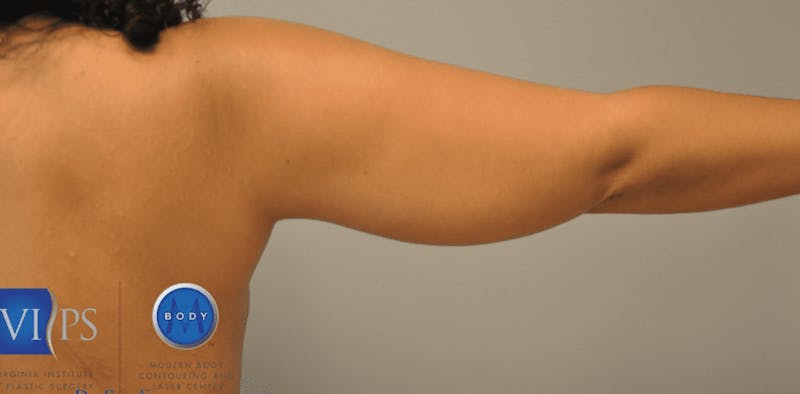 JPlasma Before & After Gallery - Patient 55345130 - Image 5