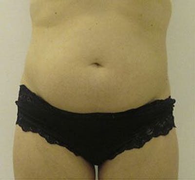 Liposonix Before & After Gallery - Patient 55345131 - Image 1