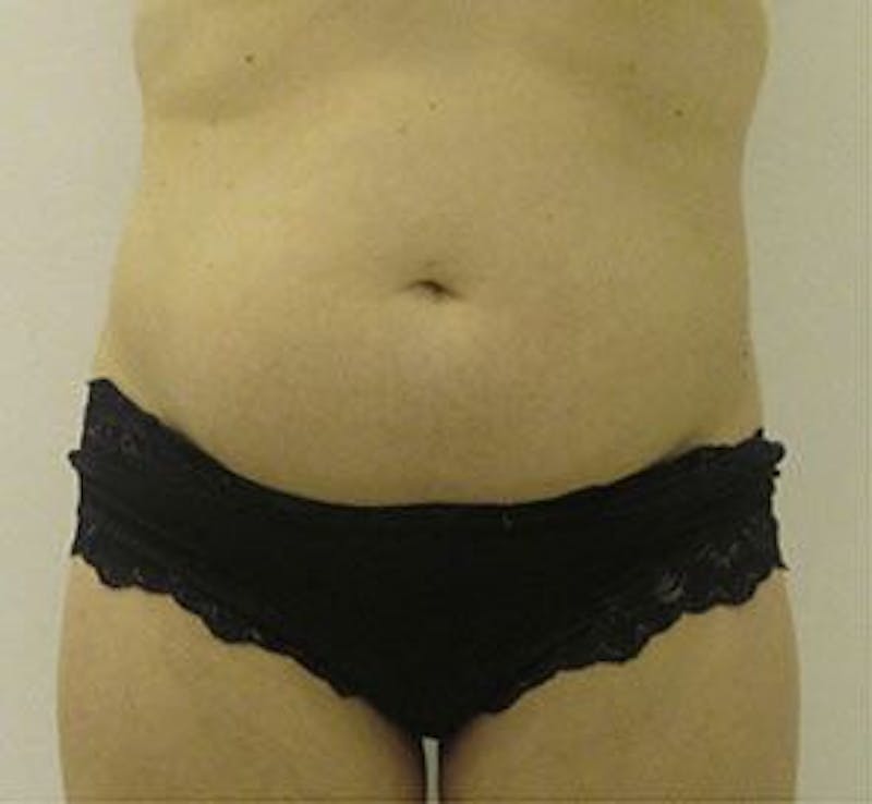 Liposonix Before & After Gallery - Patient 55345131 - Image 1
