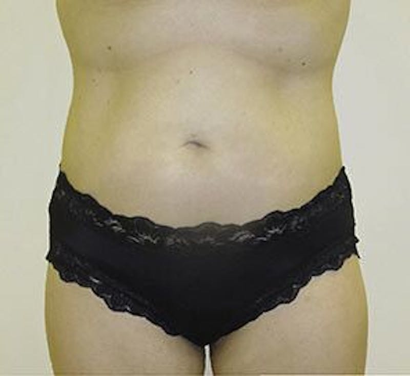 Liposonix Before & After Gallery - Patient 55345131 - Image 2