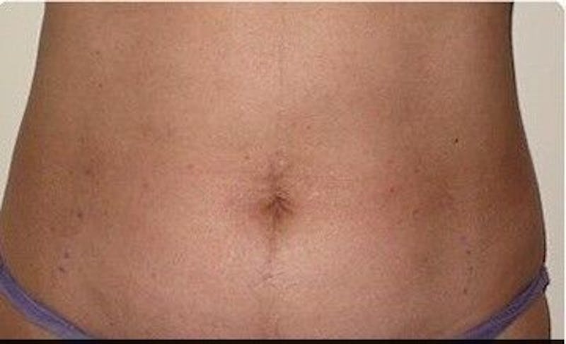 truSculpt Before & After Gallery - Patient 55345135 - Image 1