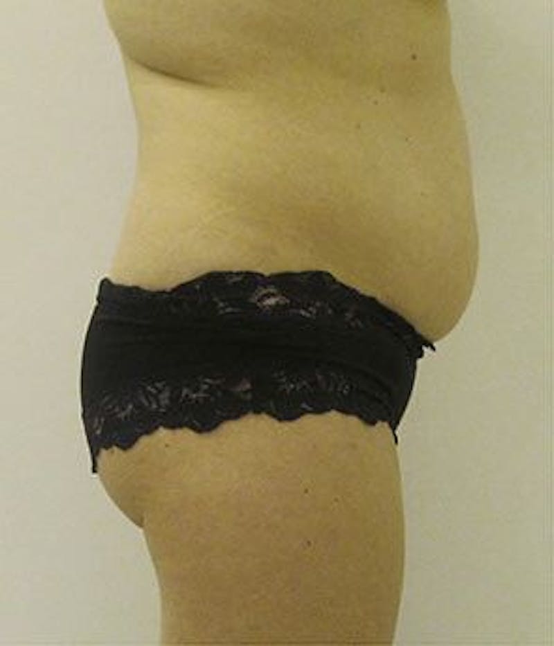Liposonix Before & After Gallery - Patient 55345131 - Image 3