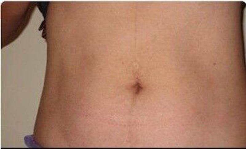 truSculpt Before & After Gallery - Patient 55345135 - Image 2