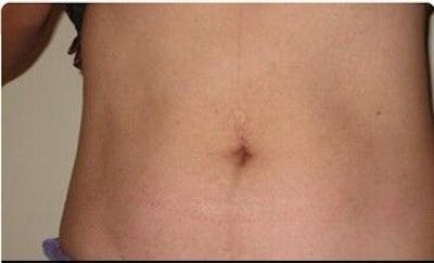 truSculpt Before & After Gallery - Patient 55345135 - Image 2