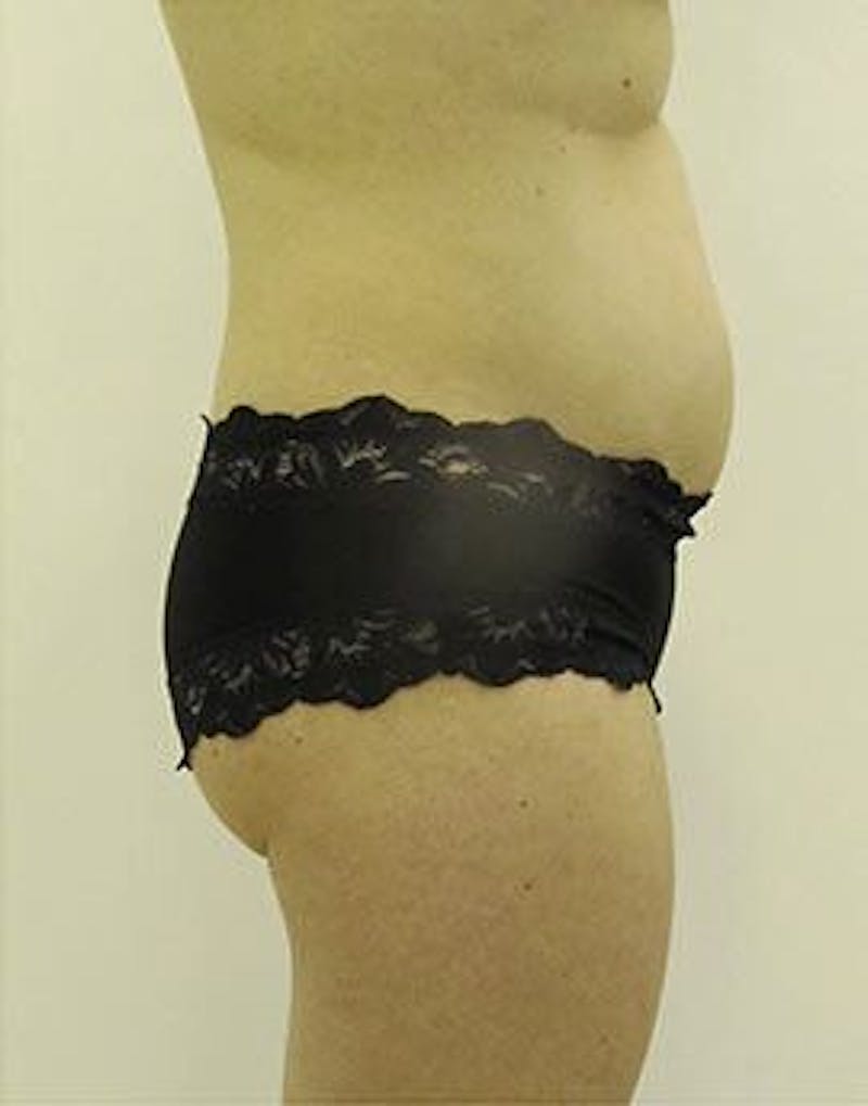 Liposonix Before & After Gallery - Patient 55345131 - Image 4