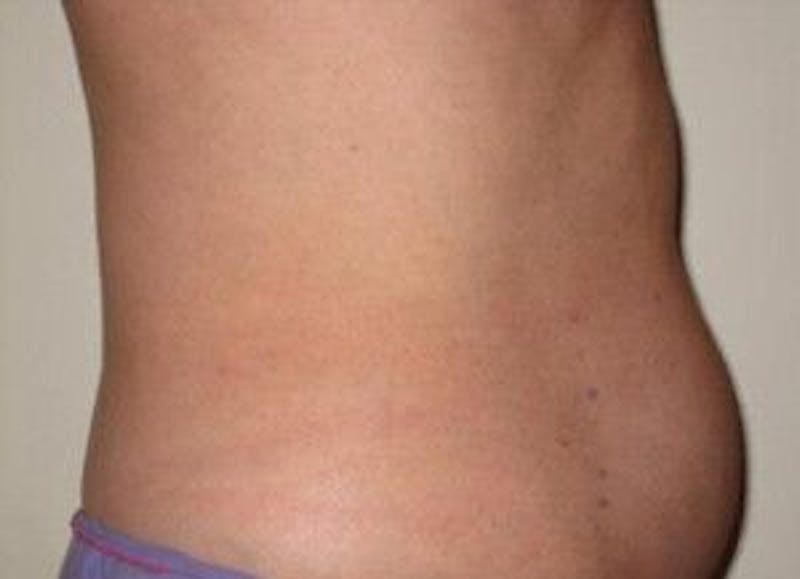 truSculpt Before & After Gallery - Patient 55345135 - Image 3