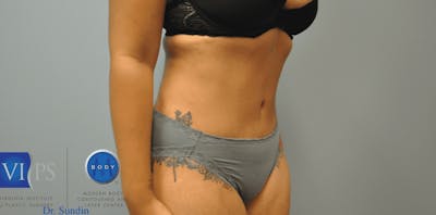 JPlasma Before & After Gallery - Patient 55345132 - Image 2