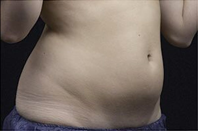Liposonix Before & After Gallery - Patient 55345136 - Image 1