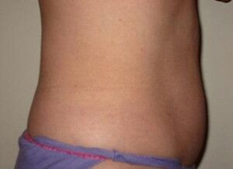 truSculpt Before & After Gallery - Patient 55345135 - Image 4