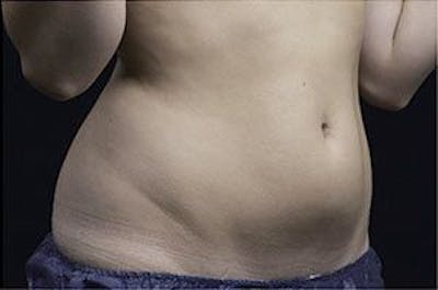 Liposonix Before & After Gallery - Patient 55345136 - Image 2