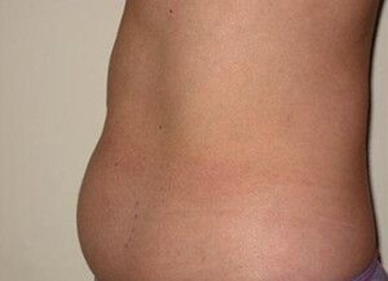 truSculpt Before & After Gallery - Patient 55345135 - Image 5