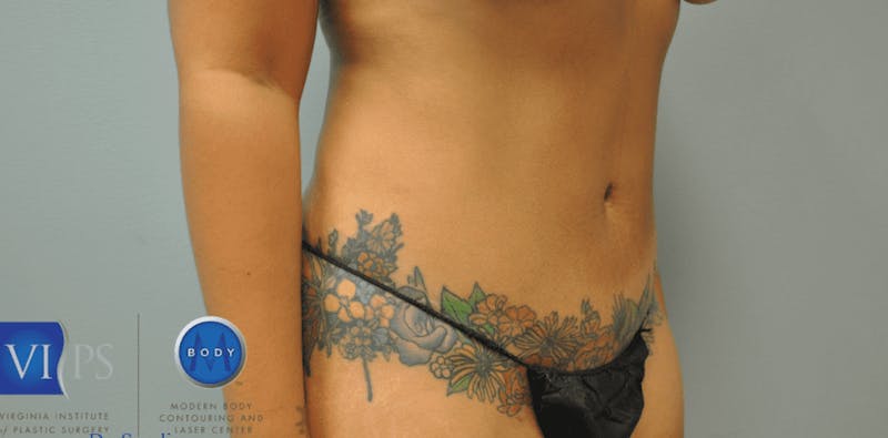 JPlasma Before & After Gallery - Patient 55345137 - Image 1