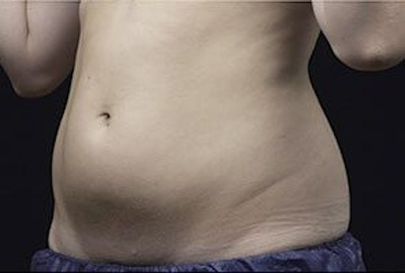 Liposonix Before & After Gallery - Patient 55345136 - Image 3