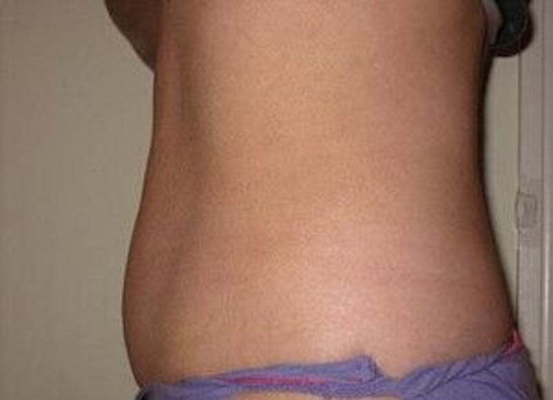 truSculpt Before & After Gallery - Patient 55345135 - Image 6