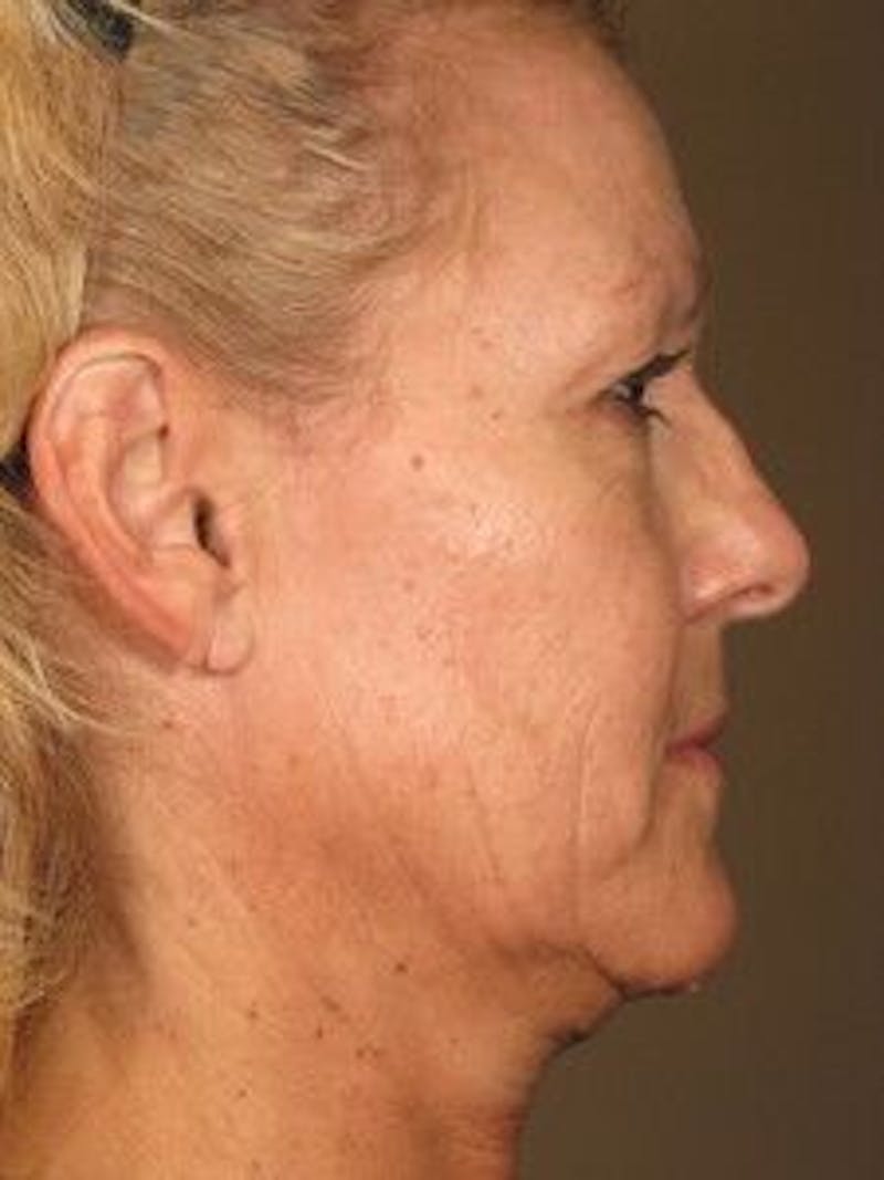 Ultherapy Before & After Gallery - Patient 55345138 - Image 1