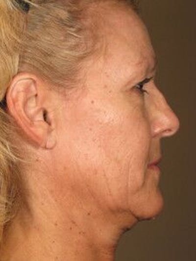 Ultherapy Gallery - Patient 55345138 - Image 1