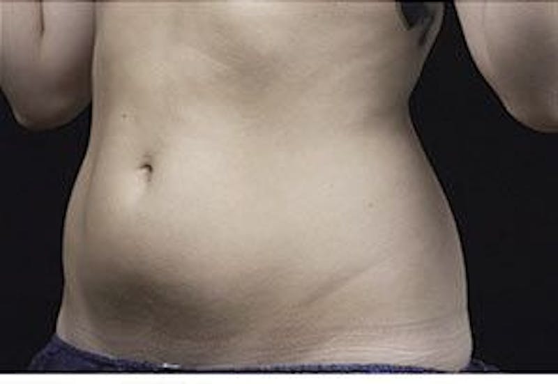 Liposonix Before & After Gallery - Patient 55345136 - Image 4