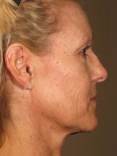 Ultherapy Before & After Gallery - Patient 55345138 - Image 2