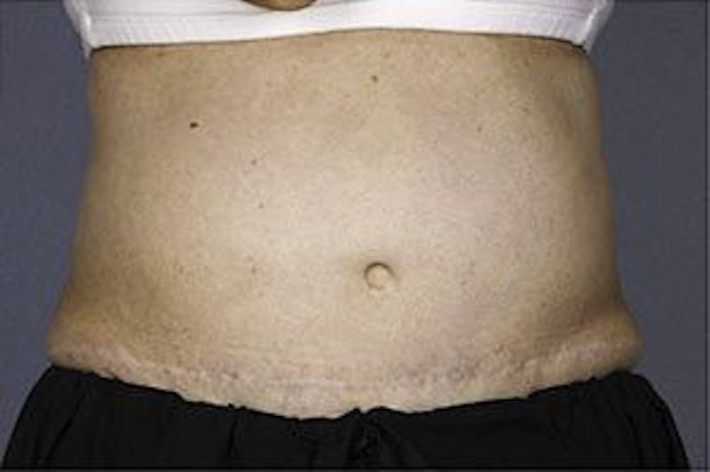 Liposonix Before & After Gallery - Patient 55345145 - Image 1