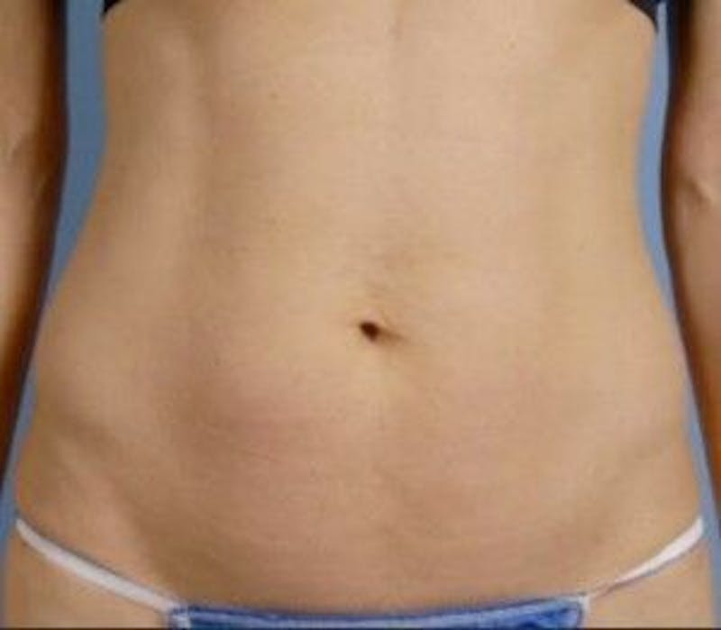 truSculpt Before & After Gallery - Patient 55345141 - Image 2