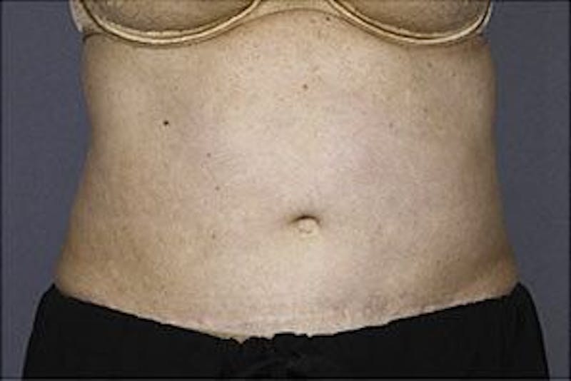 Liposonix Before & After Gallery - Patient 55345145 - Image 2