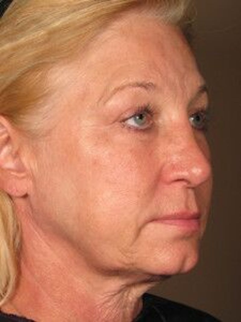 Ultherapy Before & After Gallery - Patient 55345140 - Image 1