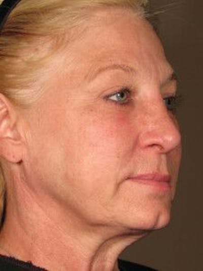 Ultherapy Before & After Gallery - Patient 55345140 - Image 2