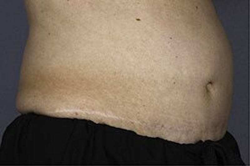 Liposonix Before & After Gallery - Patient 55345145 - Image 3