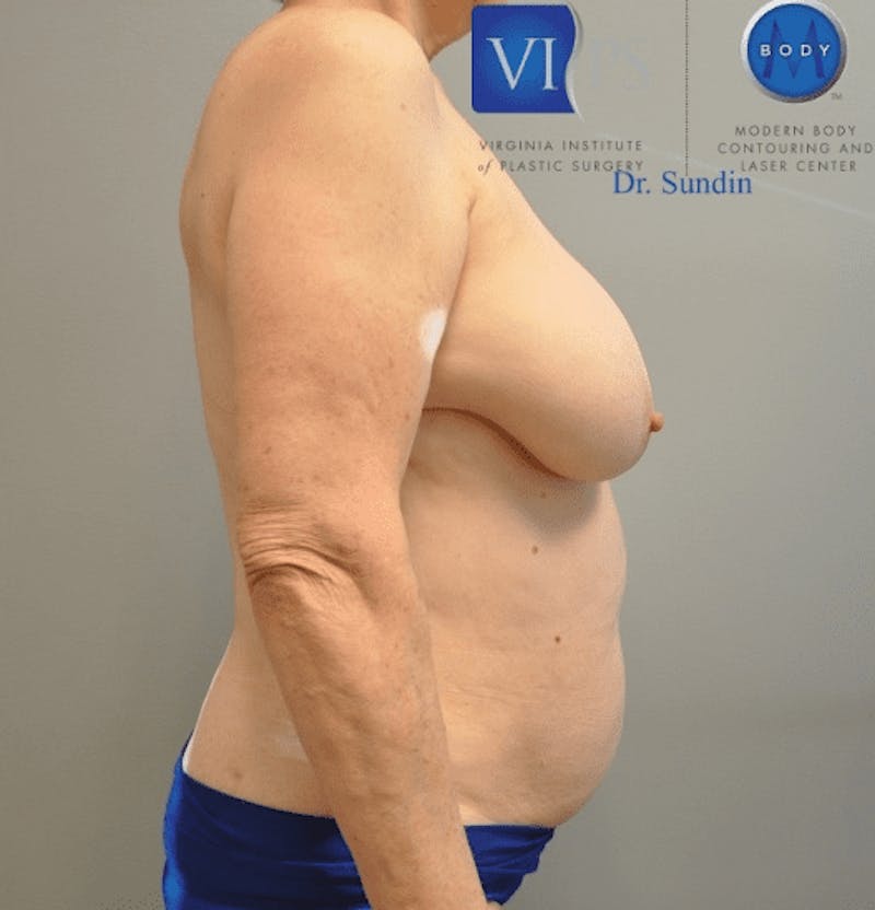 JPlasma Before & After Gallery - Patient 55345157 - Image 3
