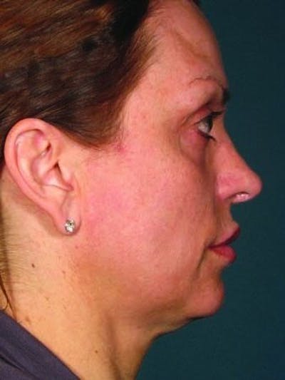 Ultherapy Before & After Gallery - Patient 55345144 - Image 1