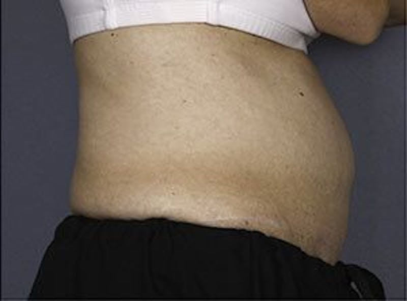 Liposonix Before & After Gallery - Patient 55345145 - Image 5