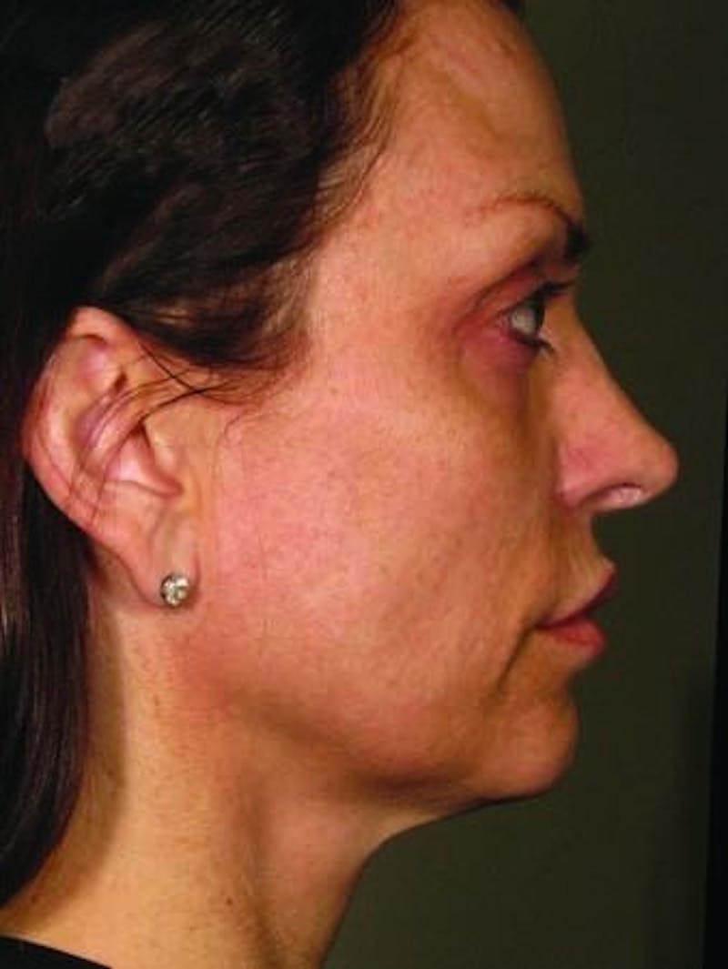 Ultherapy Before & After Gallery - Patient 55345144 - Image 2