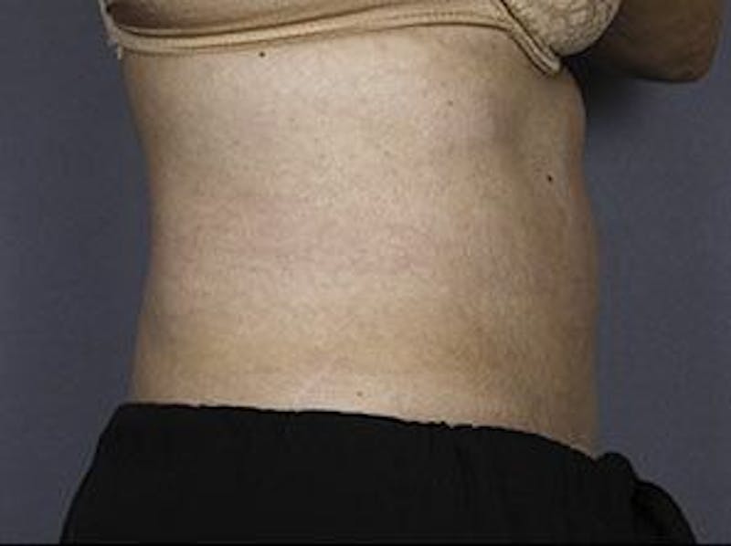 Liposonix Before & After Gallery - Patient 55345145 - Image 6