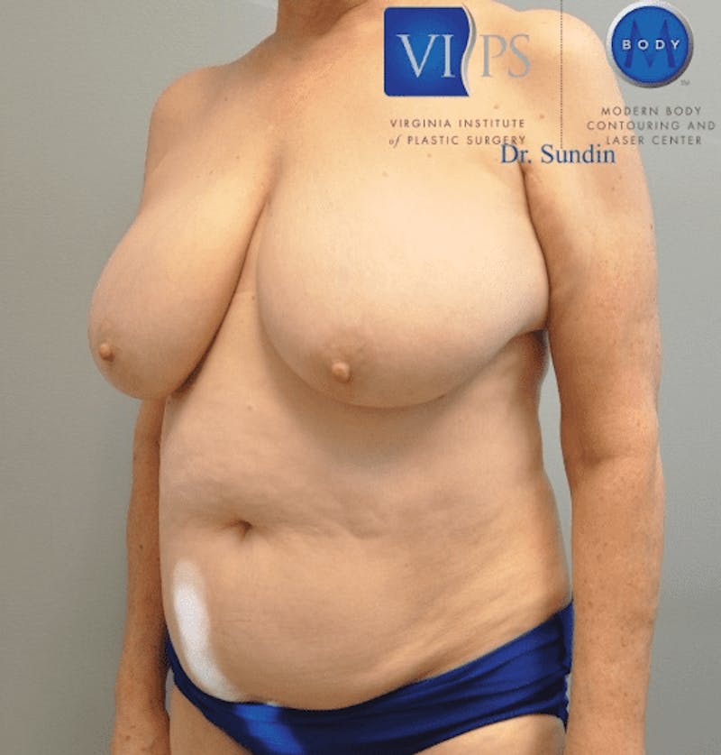 JPlasma Before & After Gallery - Patient 55345157 - Image 5