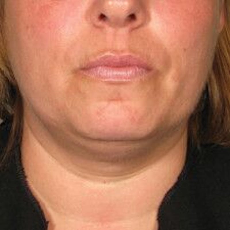 Ultherapy Before & After Gallery - Patient 55345146 - Image 1