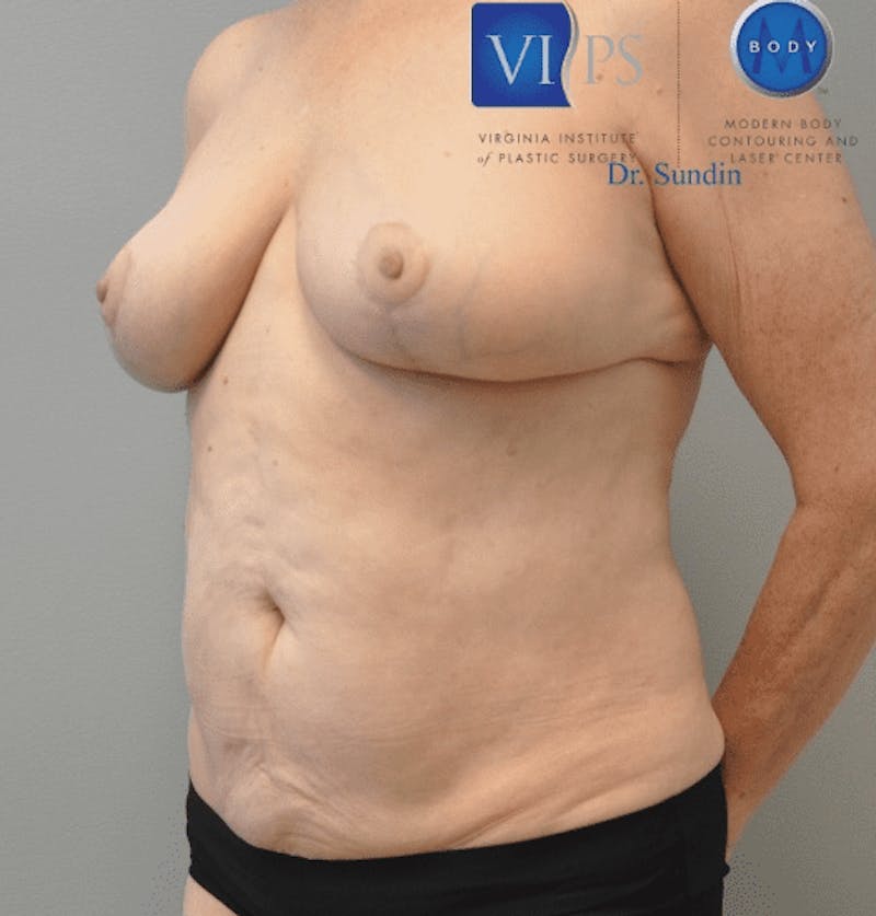 JPlasma Before & After Gallery - Patient 55345157 - Image 6