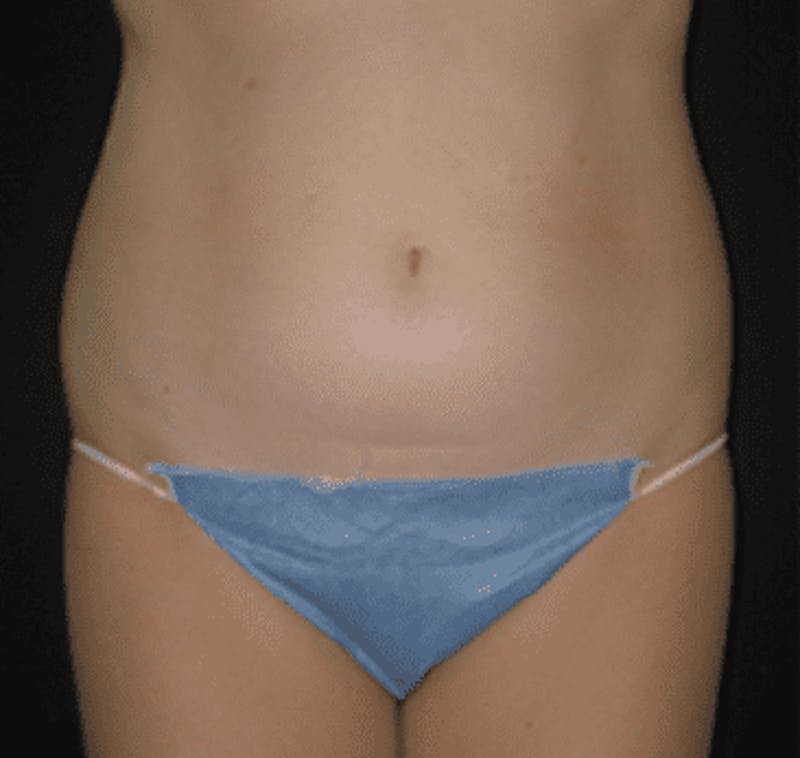 UltraShape Before & After Gallery - Patient 55345147 - Image 1